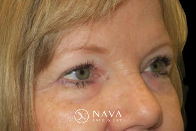 Upper Blepharoplasty (Upper Eyelid Surgery) Before & After Gallery - Patient 149265 - Image 4