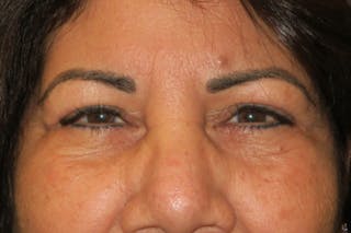 Upper Blepharoplasty (Upper Eyelid Surgery) Before & After Gallery - Patient 699549 - Image 2