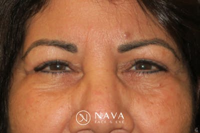Upper Blepharoplasty (Upper Eyelid Surgery) Before & After Gallery - Patient 699549 - Image 2