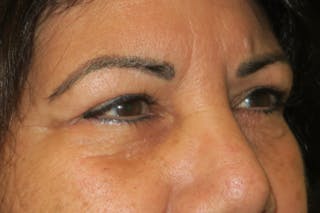 Upper Blepharoplasty (Upper Eyelid Surgery) Before & After Gallery - Patient 699549 - Image 6