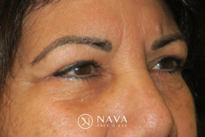 Upper Blepharoplasty (Upper Eyelid Surgery) Before & After Gallery - Patient 699549 - Image 6