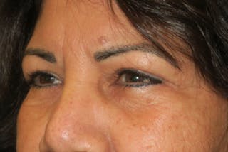 Upper Blepharoplasty (Upper Eyelid Surgery) Before & After Gallery - Patient 699549 - Image 4