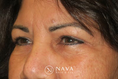 Upper Blepharoplasty (Upper Eyelid Surgery) Before & After Gallery - Patient 699549 - Image 4