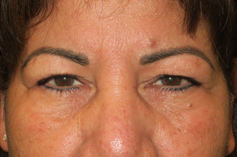 Browplasty (Brow Lift) Before & After Gallery - Patient 150042 - Image 1
