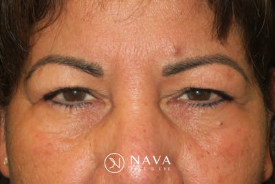 Upper Blepharoplasty (Upper Eyelid Surgery) Before & After Gallery - Patient 699549 - Image 1