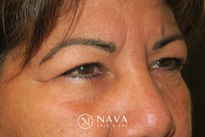 Upper Blepharoplasty (Upper Eyelid Surgery) Before & After Gallery - Patient 699549 - Image 5