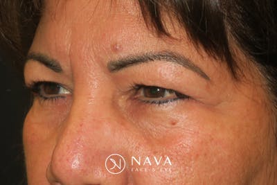 Upper Blepharoplasty (Upper Eyelid Surgery) Before & After Gallery - Patient 699549 - Image 3