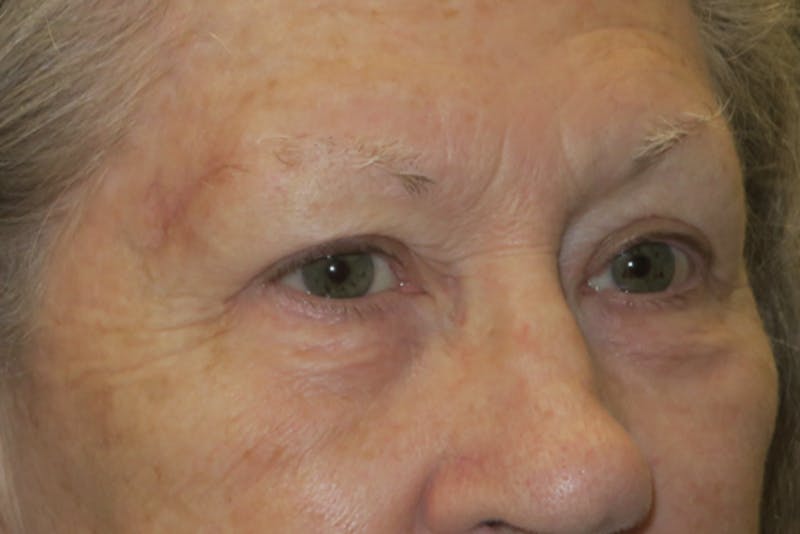 Upper Blepharoplasty (Upper Eyelid Surgery) Before & After Gallery - Patient 159344 - Image 4