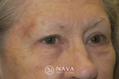 Upper Blepharoplasty (Upper Eyelid Surgery) Before & After Gallery - Patient 140394 - Image 4