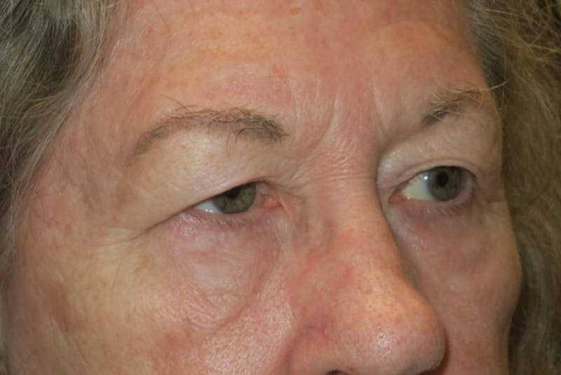 Upper Blepharoplasty (Upper Eyelid Surgery) Before & After Gallery - Patient 159344 - Image 3