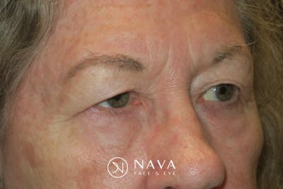 Upper Blepharoplasty (Upper Eyelid Surgery) Before & After Gallery - Patient 140394 - Image 3
