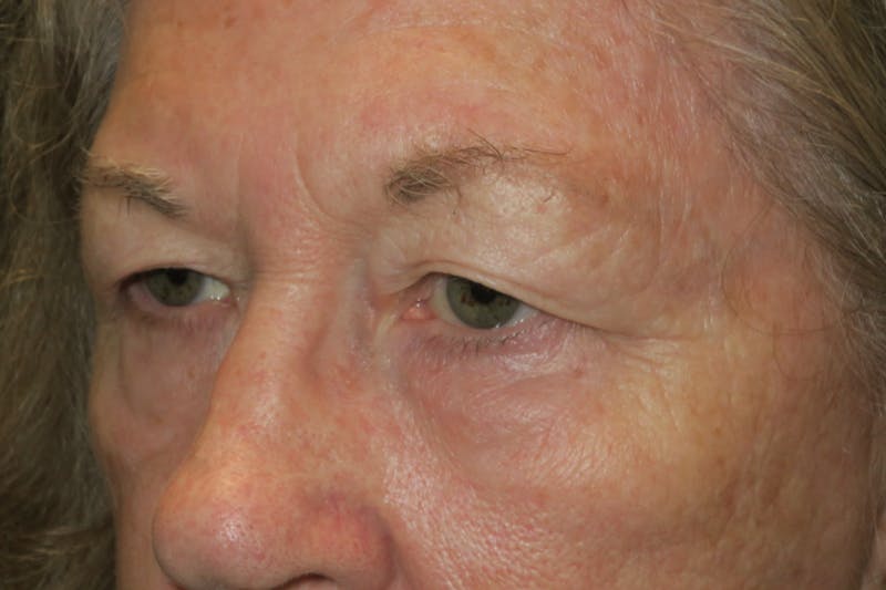 Upper Blepharoplasty (Upper Eyelid Surgery) Before & After Gallery - Patient 159344 - Image 5