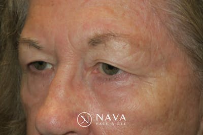 Upper Blepharoplasty (Upper Eyelid Surgery) Before & After Gallery - Patient 140394 - Image 5
