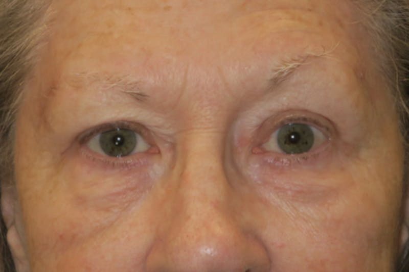 Upper Blepharoplasty (Upper Eyelid Surgery) Before & After Gallery - Patient 159344 - Image 2