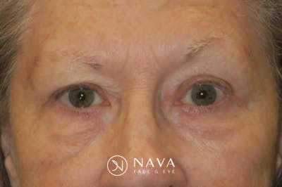 Upper Blepharoplasty (Upper Eyelid Surgery) Before & After Gallery - Patient 140394 - Image 2