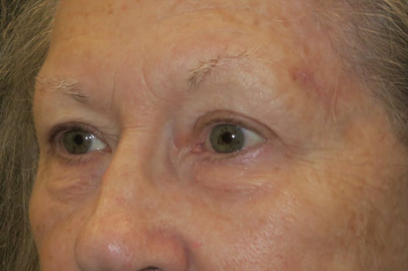 Upper Blepharoplasty (Upper Eyelid Surgery) Before & After Gallery - Patient 159344 - Image 6