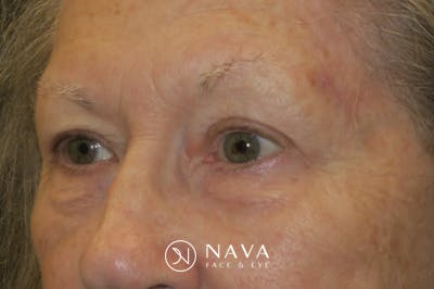 Upper Blepharoplasty (Upper Eyelid Surgery) Before & After Gallery - Patient 140394 - Image 6