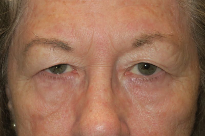 Upper Blepharoplasty (Upper Eyelid Surgery) Before & After Gallery - Patient 159344 - Image 1