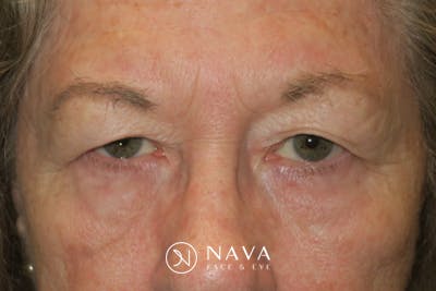 Upper Blepharoplasty (Upper Eyelid Surgery) Before & After Gallery - Patient 140394 - Image 1