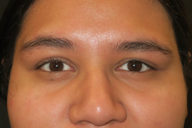 Upper Blepharoplasty (Upper Eyelid Surgery) Before & After Gallery - Patient 357480 - Image 2