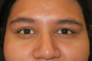 Ptosis Repair Before & After Gallery - Patient 246866 - Image 2