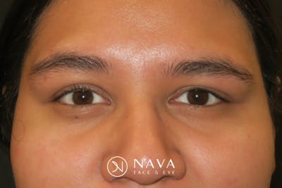 Ptosis Repair Before & After Gallery - Patient 246866 - Image 2