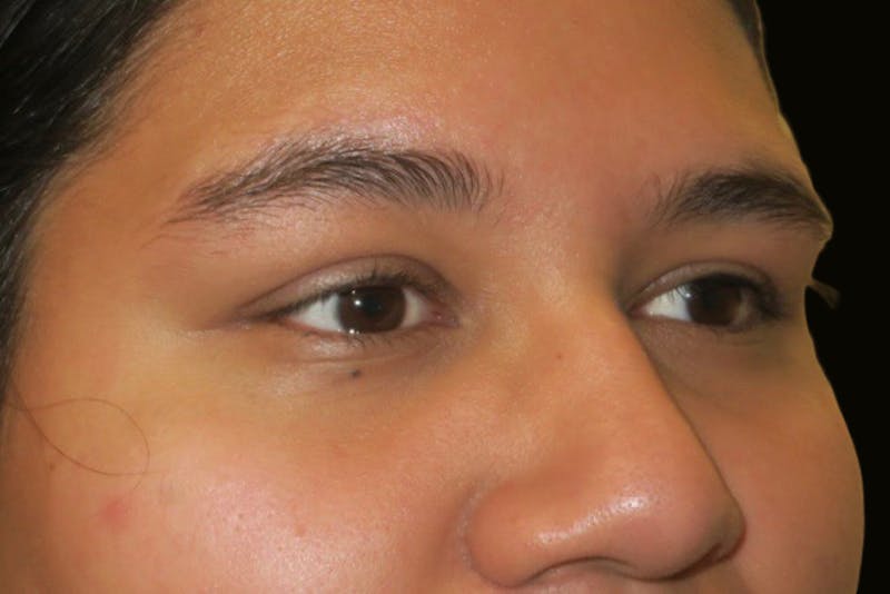 Upper Blepharoplasty (Upper Eyelid Surgery) Before & After Gallery - Patient 357480 - Image 4