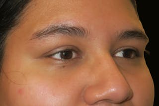 Ptosis Repair Before & After Gallery - Patient 246866 - Image 4