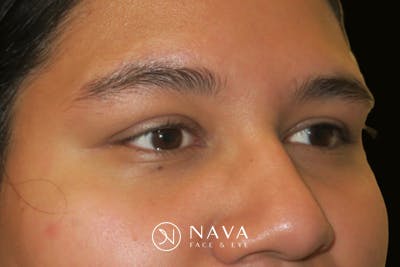 Ptosis Repair Before & After Gallery - Patient 246866 - Image 4