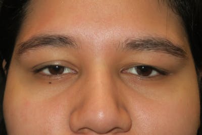 Ptosis Repair Before & After Gallery - Patient 246866 - Image 1