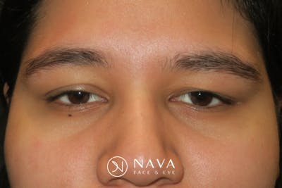 Ptosis Repair Before & After Gallery - Patient 246866 - Image 1