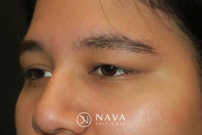Ptosis Repair Before & After Gallery - Patient 246866 - Image 5