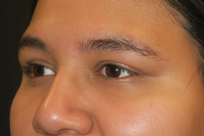 Upper Blepharoplasty (Upper Eyelid Surgery) Before & After Gallery - Patient 357480 - Image 6