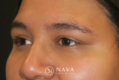 Ptosis Repair Before & After Gallery - Patient 246866 - Image 6