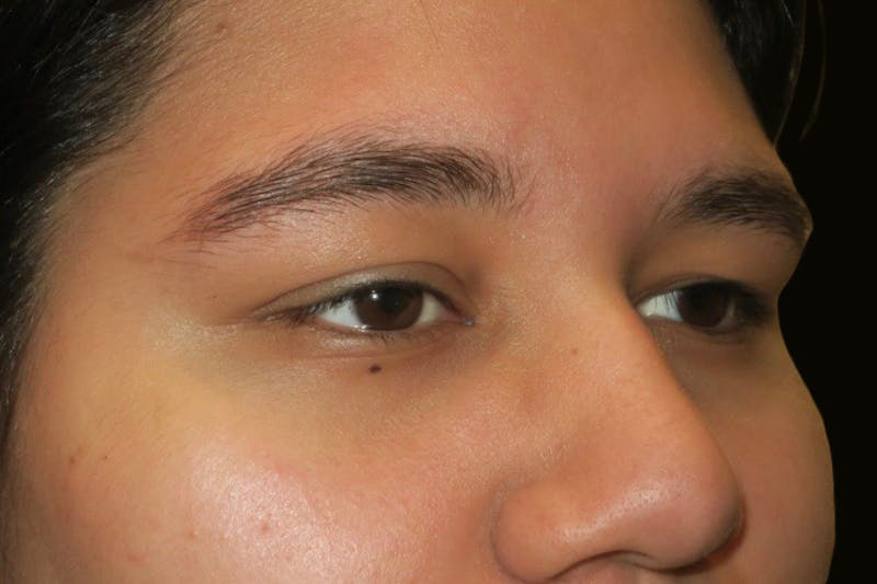 Upper Blepharoplasty (Upper Eyelid Surgery) Before & After Gallery - Patient 357480 - Image 3