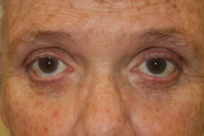 Eyelid Growth Removal Before & After Gallery - Patient 376974 - Image 2