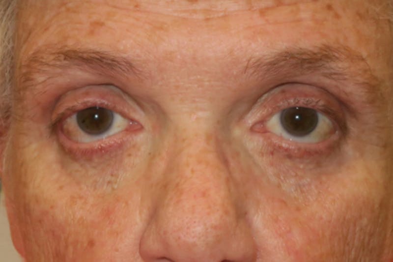 Eyelid Growth Removal Before & After Gallery - Patient 376974 - Image 1