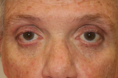 Eyelid Growth Removal Before & After Gallery - Patient 376974 - Image 1