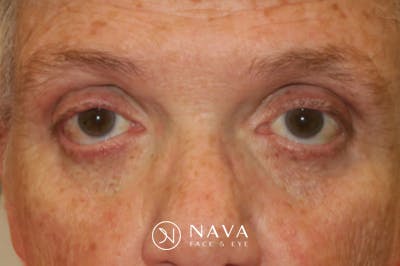 Eyelid Growth Removal Before & After Gallery - Patient 376974 - Image 1