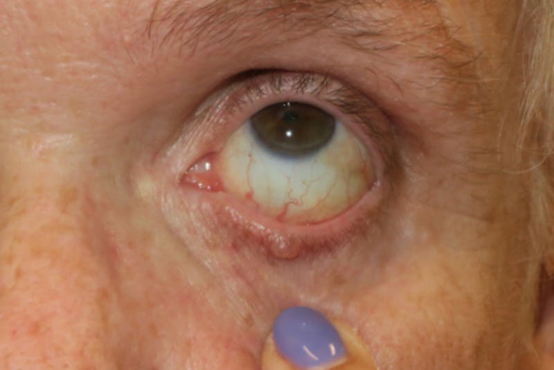 Eyelid Growth Removal Before & After Gallery - Patient 376974 - Image 3