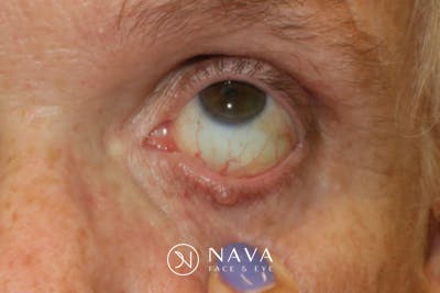Eyelid Growth Removal Before & After Gallery - Patient 376974 - Image 3