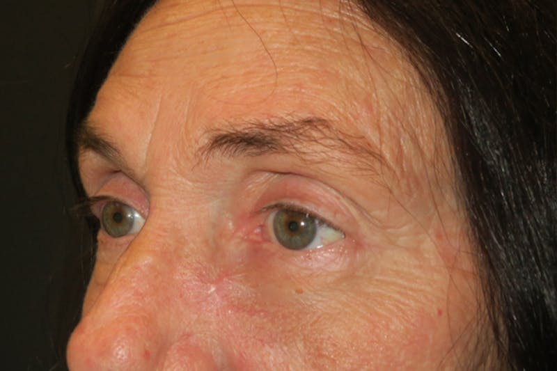Ptosis Repair Before & After Gallery - Patient 162861 - Image 4
