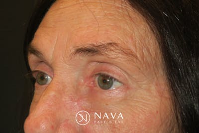 Ptosis Repair Before & After Gallery - Patient 162861 - Image 4