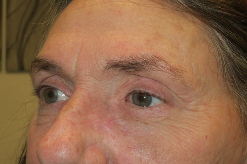 Ptosis Repair Before & After Gallery - Patient 162861 - Image 3