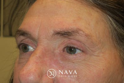 Ptosis Repair Before & After Gallery - Patient 162861 - Image 3