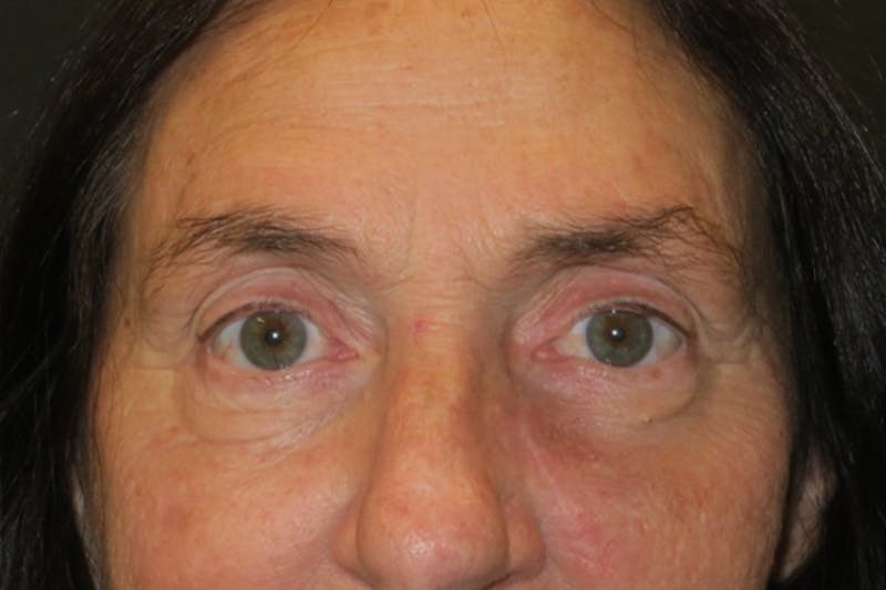Ptosis Repair Before & After Gallery - Patient 162861 - Image 2