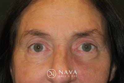 Ptosis Repair Before & After Gallery - Patient 162861 - Image 2
