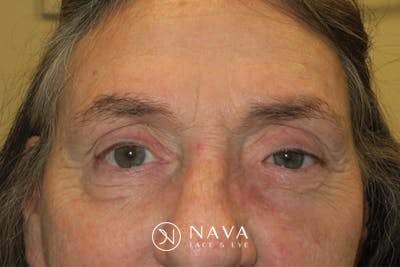 Ptosis Repair Before & After Gallery - Patient 162861 - Image 1