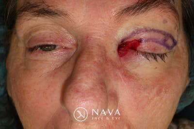 Ptosis Repair Before & After Gallery - Patient 162861 - Image 5