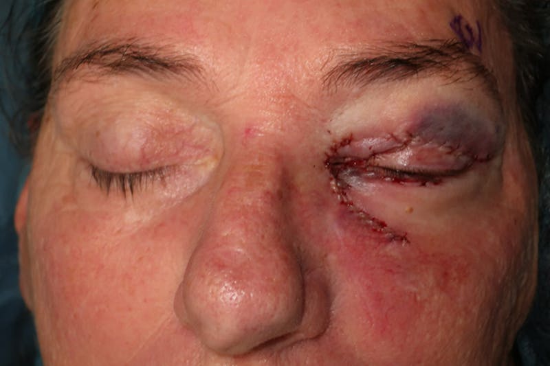Ptosis Repair Before & After Gallery - Patient 162861 - Image 6